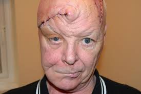 Regarding safety, the doublet was. Grandad Loses Half His Scalp After Stubborn Spot Turns Out To Be Skin Cancer That S Spread Like Flesh Eating Bug