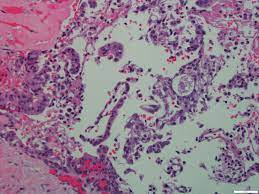 Mucoepidermoid carcinoma is the most common malignant neoplasm of the salivary gland. Pathology Outlines Mucoepidermoid Carcinoma
