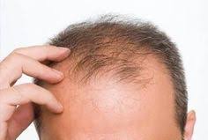 Sampuaniniza Ekleyeceginiz 2 Madde Ile Sac Dokulmesini Durdurabilir Saglikli Saclara Sahip Olabilirsiniz Sac Doku Hair Loss Men Stop Hair Loss Help Hair Loss