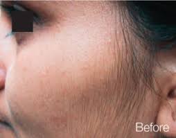 Several hair removal systems have been shown to be effective in this setting: Looking For Reasons To Do Laser Hair Removal Check These Out Wellbeing Clinic