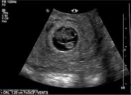 Image result for First Trimester Ultrasound