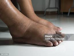 Image result for toe black diabetes