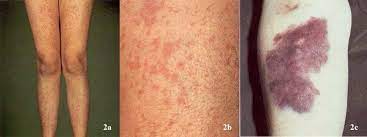 Large extravasation of blood into the skin is known as ecchymosis. A And 2b Shows Scattered Petechiae And Purpura And Figure 2c Shows A Download Scientific Diagram