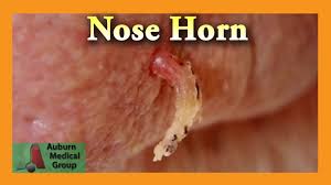 Just a cutaneous (keratotic) horn? Cutaneous Horn Removal Auburn Medical Group Youtube