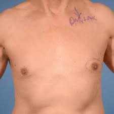 A man's risk for breast cancer increases if he has a family history of breast cancer or a gene mutation such as brca2. Pdf Neoadjuvant Chemotherapy For Male Breast Cancer Pushing The Boundaries