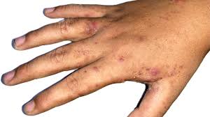Image result for skin rash similar to scabies