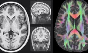 Faisant partie de la famille des maladies dégénératives, la maladie de charcot se caractérise par une dégénérescence progressive des neurones qui contrôlent. Maladie De Charcot Ou En Est La Recherche