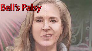 Generally, bell's palsy affects only one side of the face, but it can affect both sides. Bell S Palsy Causes Symptoms Diagnosis Recovery Treatment