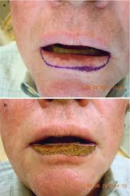 Image result for Lip Cancer
