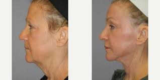 Timothy M. Greco, MD, FACS, Board Certified Facial Plastic Surgeon