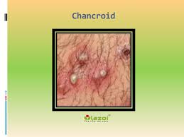 Image result for chancroid