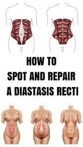 12 Best Umbilical Hernia Repair Ideas Umbilical Hernia Umbilical Hernia Repair Hernia Repair