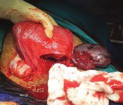 Ovarian cysts in Pregnancy: Obstetric Outcome and Management