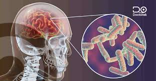 الالتهاب السحائي Meningitis دكتورك الالتهاب السحائي هو التهاب للأغشية المحيطة بالمخ