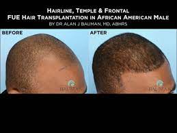 For most black men in my practice, a preference for fue is seen. Q Does Hair Transplantation Work For Ethnic Or African American Hair Bauman Medical