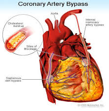 Definition Of Coronary Artery Bypass Graft