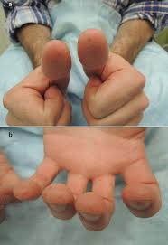 Image result for Hand foot and mouth disease HFMD roof of mouth