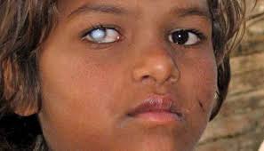 On rare occasions, it can occur on the outermost layer on the front of the eye (the conjunctiva), in the socket that surrounds the eye, or the eyelid itself.﻿﻿ White Spot On Eye Causes Symptoms And Treatment