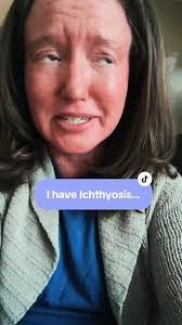 #ichthyosis #ichthyosisawareness #chronicillness #chronicillnessawareness  #disability #ofcoursetrend #momsoftiktok #dryskin #heatintolerance  #socialanxiety
