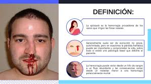 Epistaxis