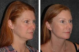 Facelift. american society for dermatologic surgery: Mini Facelift World Renown Mini Facelift Specialist In New York