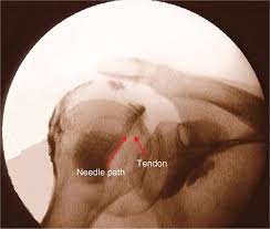 Image result for Biceps Tendon Injection