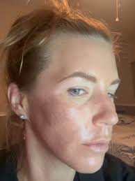 ✨ Peel Progress in Action! ✨, Check out these 3 videos showing the  real-time transformation from a SkinCeuticals Smart TCA Chemical Peel! 🧪,  We know chemical peel might sound a little intense—but ...