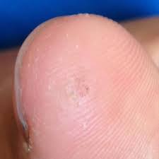Was Konnt Das Sein Der Beginn Einer Warze Am Finger Weil Hab Am Fuss Eine Warze Dort Sind Auch Solche Kleine Schwarze Punkte Drin Warzen Konnen