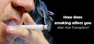 Nicotine decreases the supply of blood to the hair follicles. Is It Possible To Continue Smoking After Hair Transplant Natural Hair Turkey