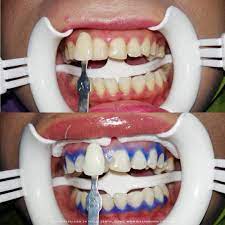 Semua orang nak gigi putih berseri kan bila senyum pun confident & happy. Buat Rawatan Whitening Teeth Putihkan Gigi Di Klinik Pergigian Dr Feeliz Dental Clinic Emas Putih