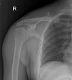 Image result for icd 10 code for left shoulder hill sachs lesion