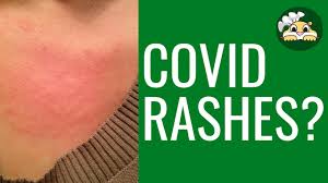 If your eczema or skin problems have gotten worse during covid, this video will show how to relieve itchy skin naturally.get more clear skin tips and. Is Your Skin Rash A Covid 19 Symptom Youtube