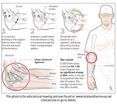 We have been receiving many questions recently regarding athletes who have had tommy john surgery and are returning to throwing and are experiencing some pain or discomfort. Tommy John Surgery Hand Therapy Elbow Surgery Occupational Therapy