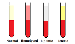 tests affected by hemolyzed lipemic and icteric samples and