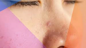 Turns out, your ears (and the area behind and around them) actually contain oil glands, which produce sebum — the oily stuff that causes clogged pores and sebaceous cysts. How To Get Rid Of And Prevent A Pimple Inside Your Nose