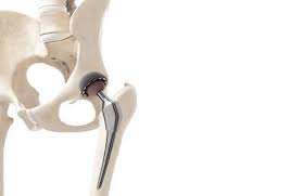 How much does a hip arthroscopy cost? Hip Replacement Surgery Procedure Risks Benefits Recovery And Cost