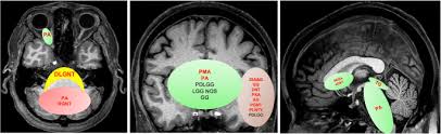 Ems & paramedic support, gang prevention, melanoma, metastatic breast cancer, mourning, pow/mia and skin learn which color ribbon goes with which cancer, and what color covers all cancers or rare cancers. Radiohistogenomics Of Pediatric Low Grade Neuroepithelial Tumors Springerlink