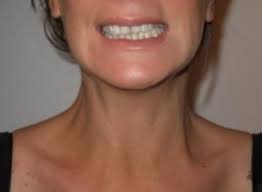 Maybe you would like to learn more about one of these? Botox Injections For Nefertiti Neck Lift Woodford Medical