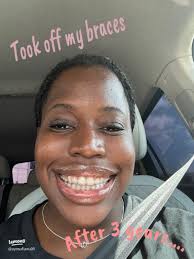 Removing Braces After 3 Years: My Transformation Journey