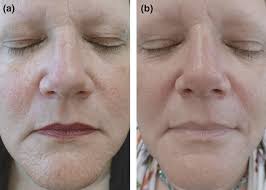 Multiple facial papules