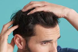 Hair loss (alopecia) can affect just your scalp or your entire body, and it can be temporary or permanent. Five Common Causes For Hair Loss And How You Can Combat It Daily Record