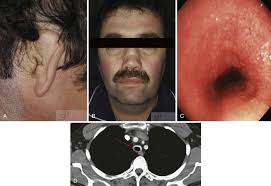 Image result for Relapsing Polychondritis