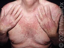 Image result for Photodermatitis