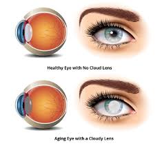 By age 80, more than half of all americans either have a cataract or have had cataract surgery. Cataract Surgery In Atlanta Eye Consultants Of Atlanta