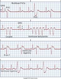 Various Forms Of Premature Ventricular Contractions Pvcs Medical Surgical Nursing Icu Nursing Cardiology Nursing