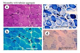 Image result for Myopathy