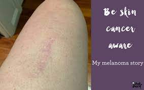 The ultraviolet radiation or uv rays given off by the sun can mutate skin cells and turn them cancerous. Be Skin Cancer Aware My Melanoma Story Just As Juicy