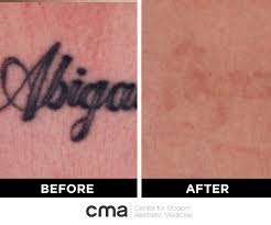 However, there is a laser tattoo removal specialist that work also in melbourne that have just bought the piqo4 device. Tattoo Removal Cma Medicine Laser Hair Removal Tattoo Removal Vaginal Rejuvenation