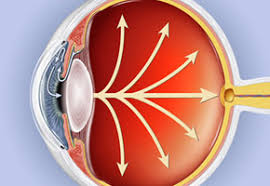This is the most common type. What Are The Symptoms Of Glaucoma Glaucoma Research Foundation