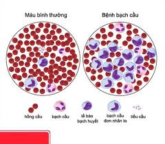 Bệnh tăng bạch cầu đơn nhân là gì? Nguyên nhân và cách điều trị